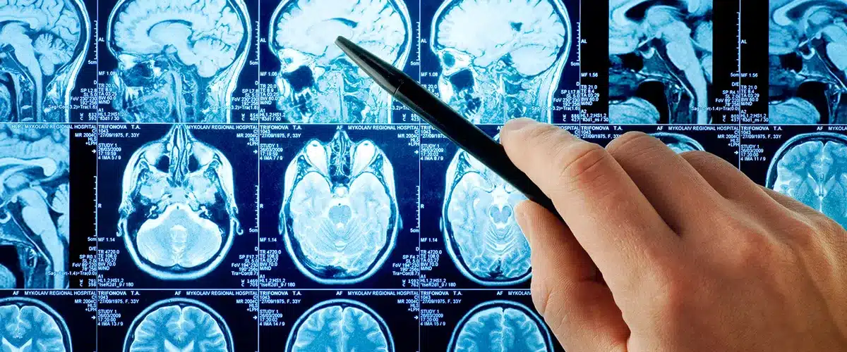 PTSD Symptom Reductions in Clinical Trial Are Linked to Changes in ...